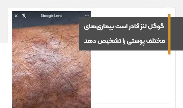 Google Lens is able to diagnose various skin diseases
